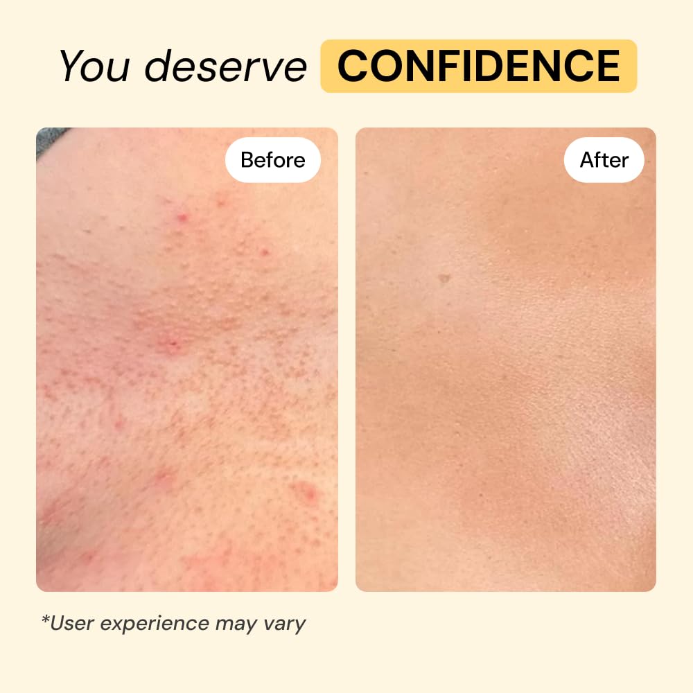 MyMagicHealer Universal Flare Care – Multi-Purpose Solution | Skin Flare-Ups - Hidradenitis Suppurativa, Folliculitis, Boils, Cysts