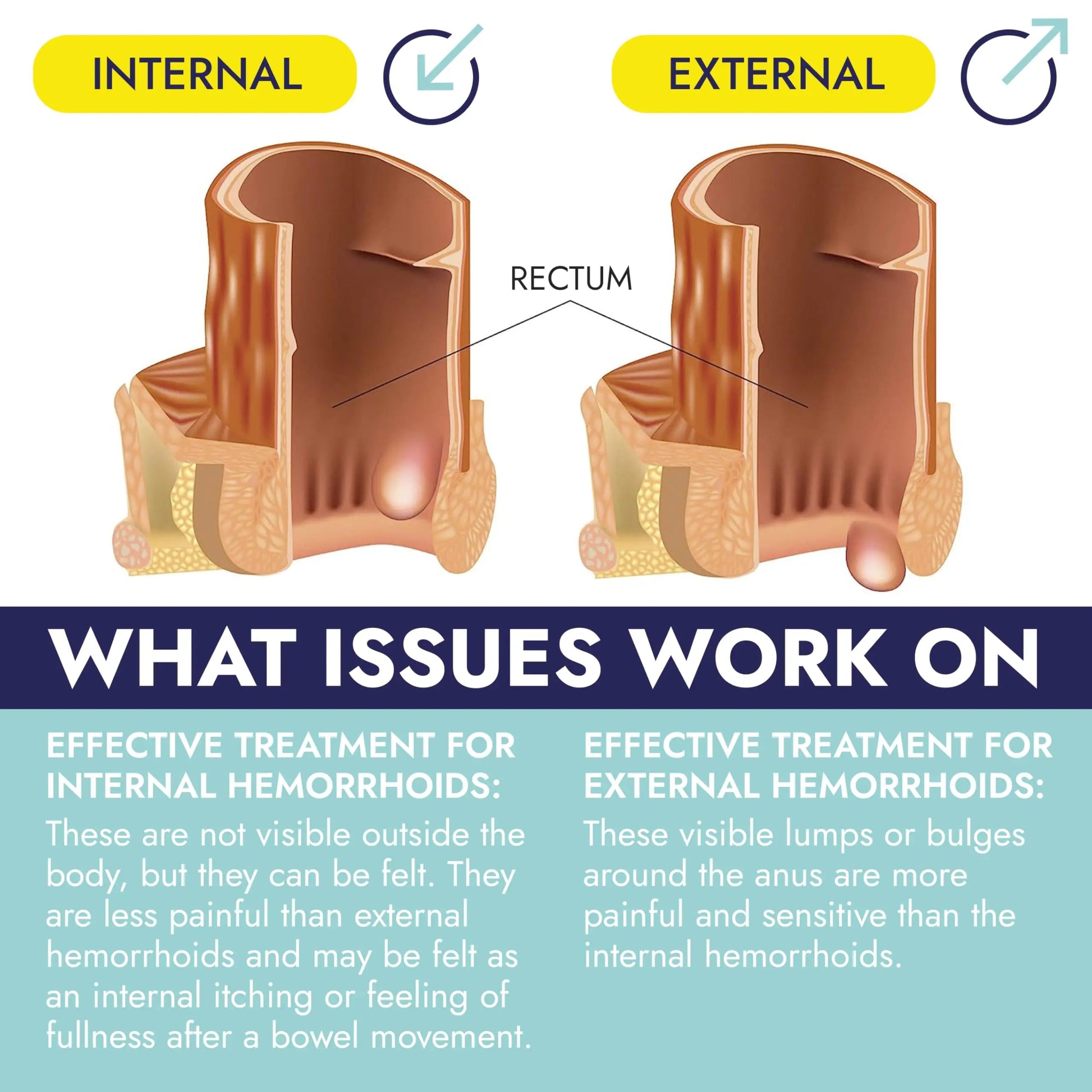 Hemorrhoid Treatment | Hemorrhoid Ointment | Hemorrhoid & Fissure Ointment | 7 Pre-Filled Applicators | Fast & Effective Relief | Reduces Swelling, Itching & Discomfort | Advanced Formula Terramed Just Think ComfortBuy Supplements Australia