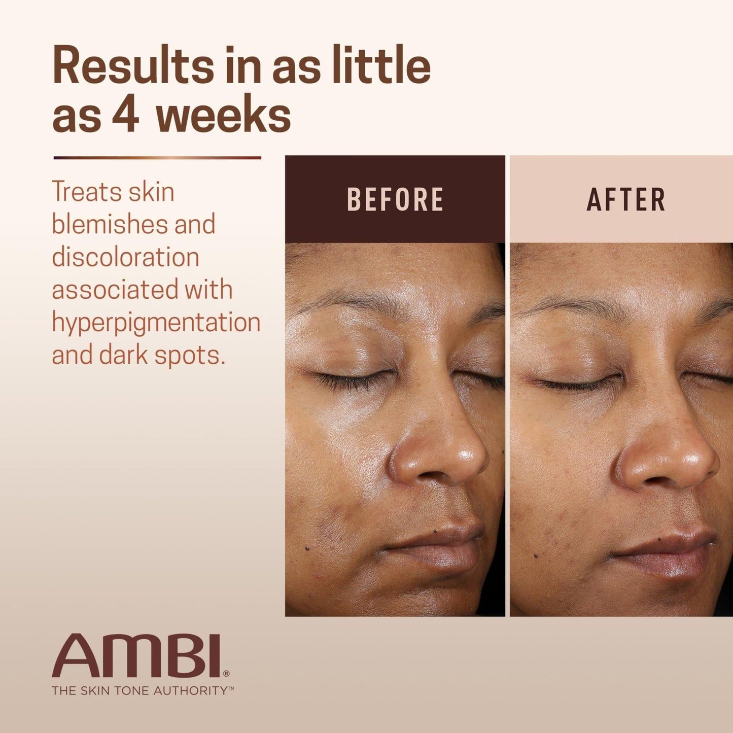 Ambi Even & Clear Advanced Fade Cream, Hydroquinone-free, Hyperpigmentation Treatment, Stubborn Dark Spot Corrector, Results In As Little As 2-3 Weeks - PrimeBioHealth - canada supplements