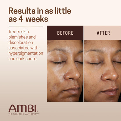 Ambi Even & Clear Advanced Fade Cream, Hydroquinone-free, Hyperpigmentation Treatment, Stubborn Dark Spot Corrector, Results In As Little As 2-3 Weeks - PrimeBioHealth - canada supplements