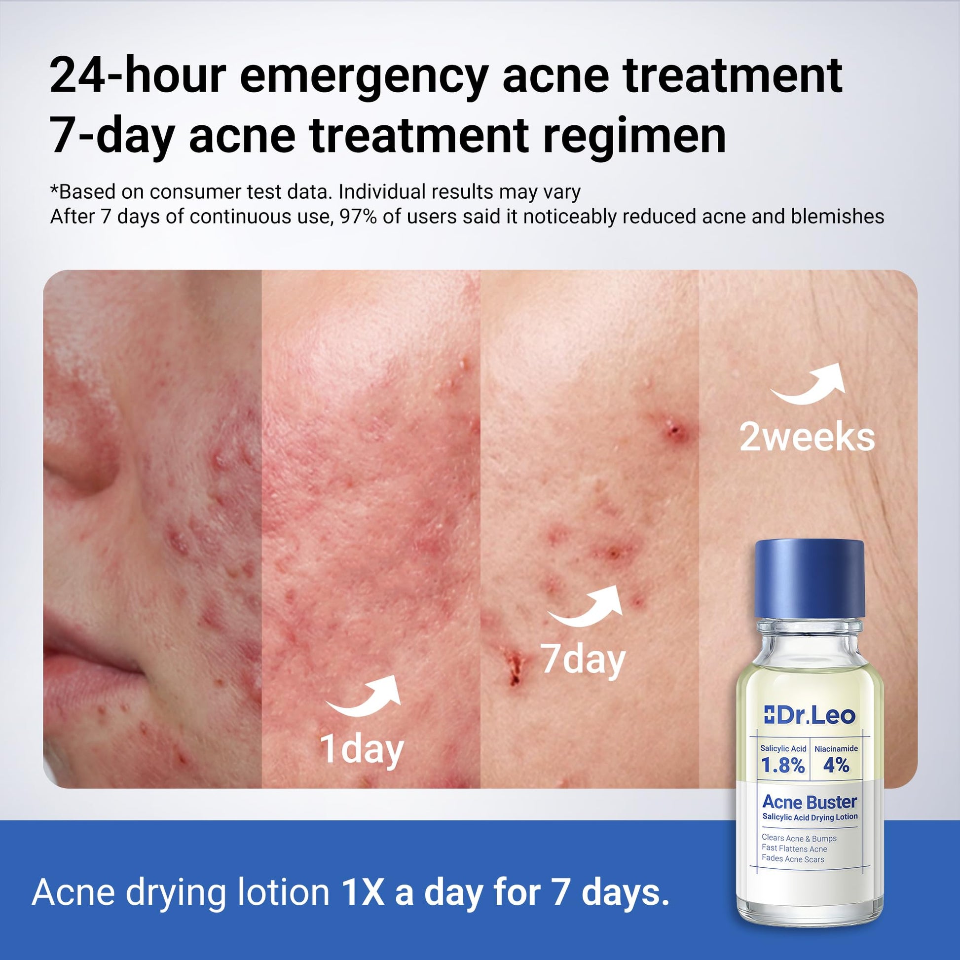 Dr.Leo 1.8% Salicylic Acid Spot Serum, Acne Treatment for Acne-Prone Sensitive Skin | Niacinamide, Fast Pimple Relief, Fades Acne Marks - PrimeBioHealth - canada supplements