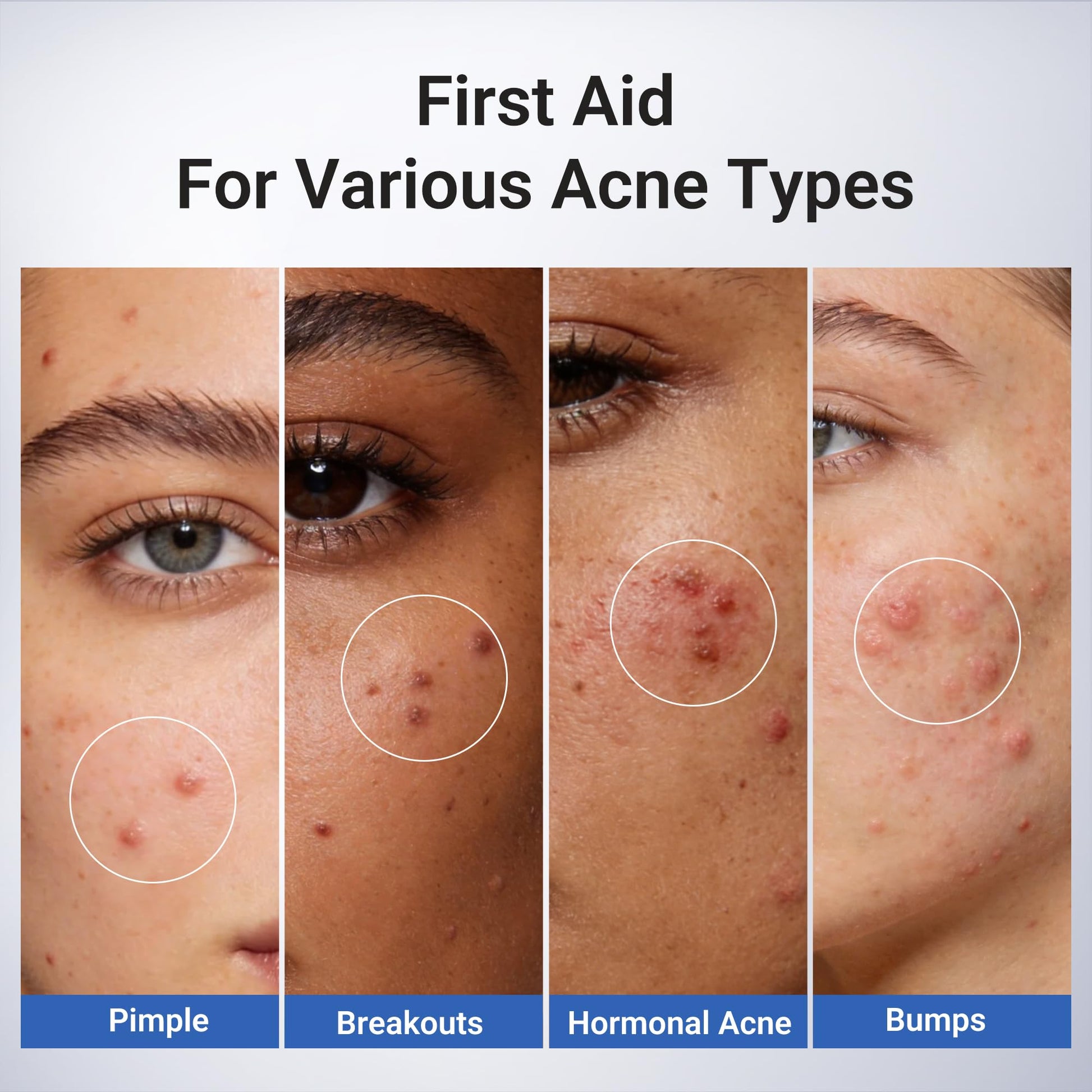 Dr.Leo 1.8% Salicylic Acid Spot Serum, Acne Treatment for Acne-Prone Sensitive Skin | Niacinamide, Fast Pimple Relief, Fades Acne Marks - PrimeBioHealth - canada supplements