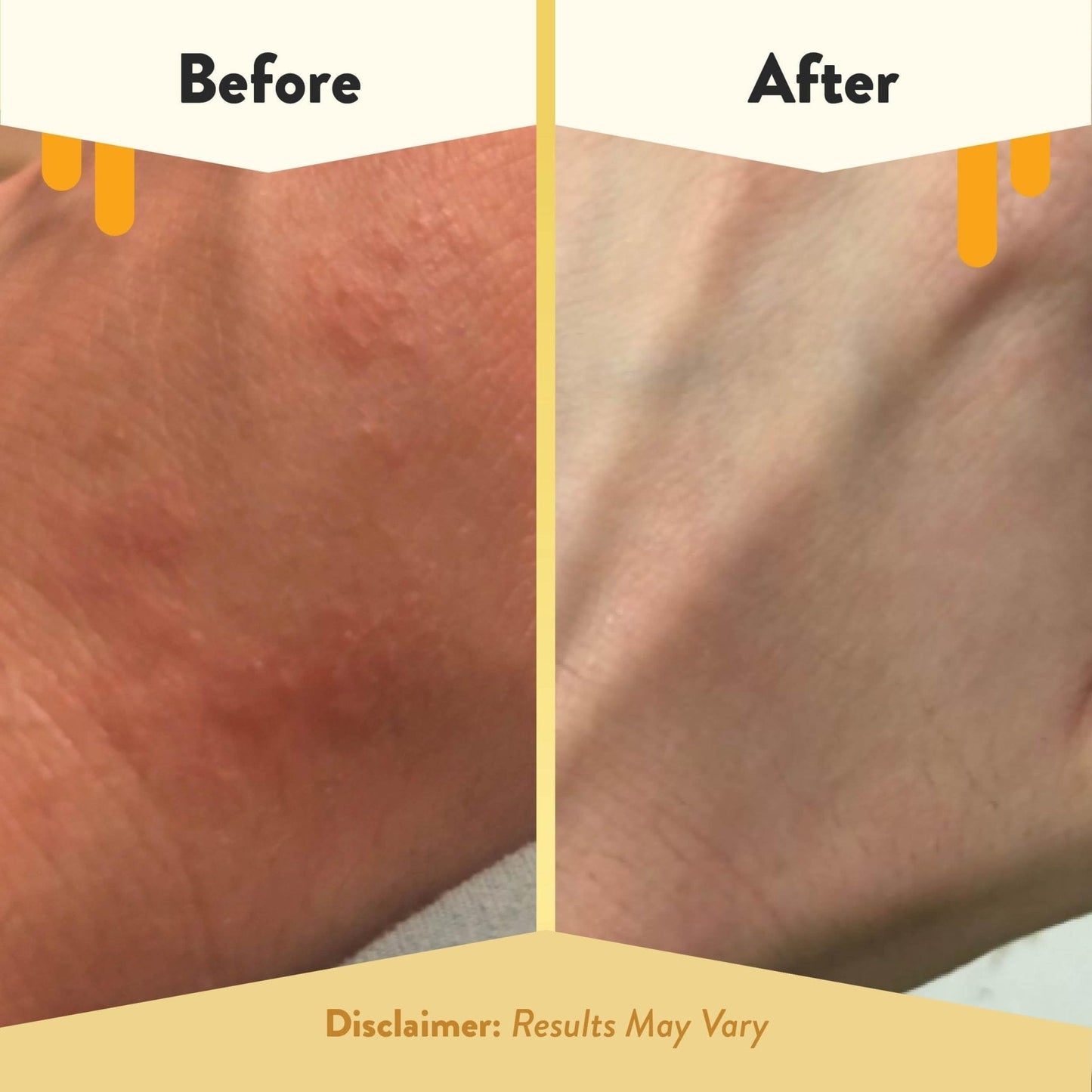 ECZEMA HONEY Oatmeal Body Lotion - Hand & Body Cream for Eczema Relief - Natural Dry Skin Repair (16 Oz) - PrimeBioHealth - canada supplements