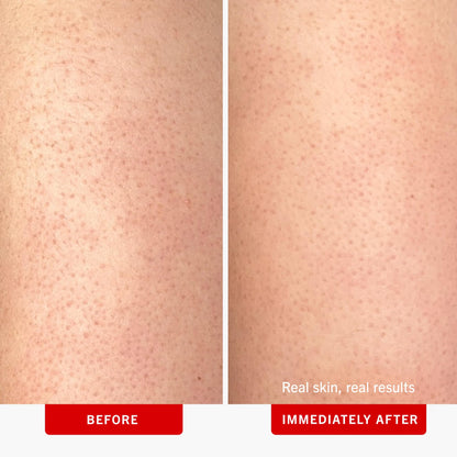 First Aid Beauty - KP Bump Eraser Body Scrub with 10% AHA, Keratosis Pilaris Exfoliator with Glycolic and Lactic acids, Helps Reduce Chicken Skin Bumps - PrimeBioHealth - canada supplements