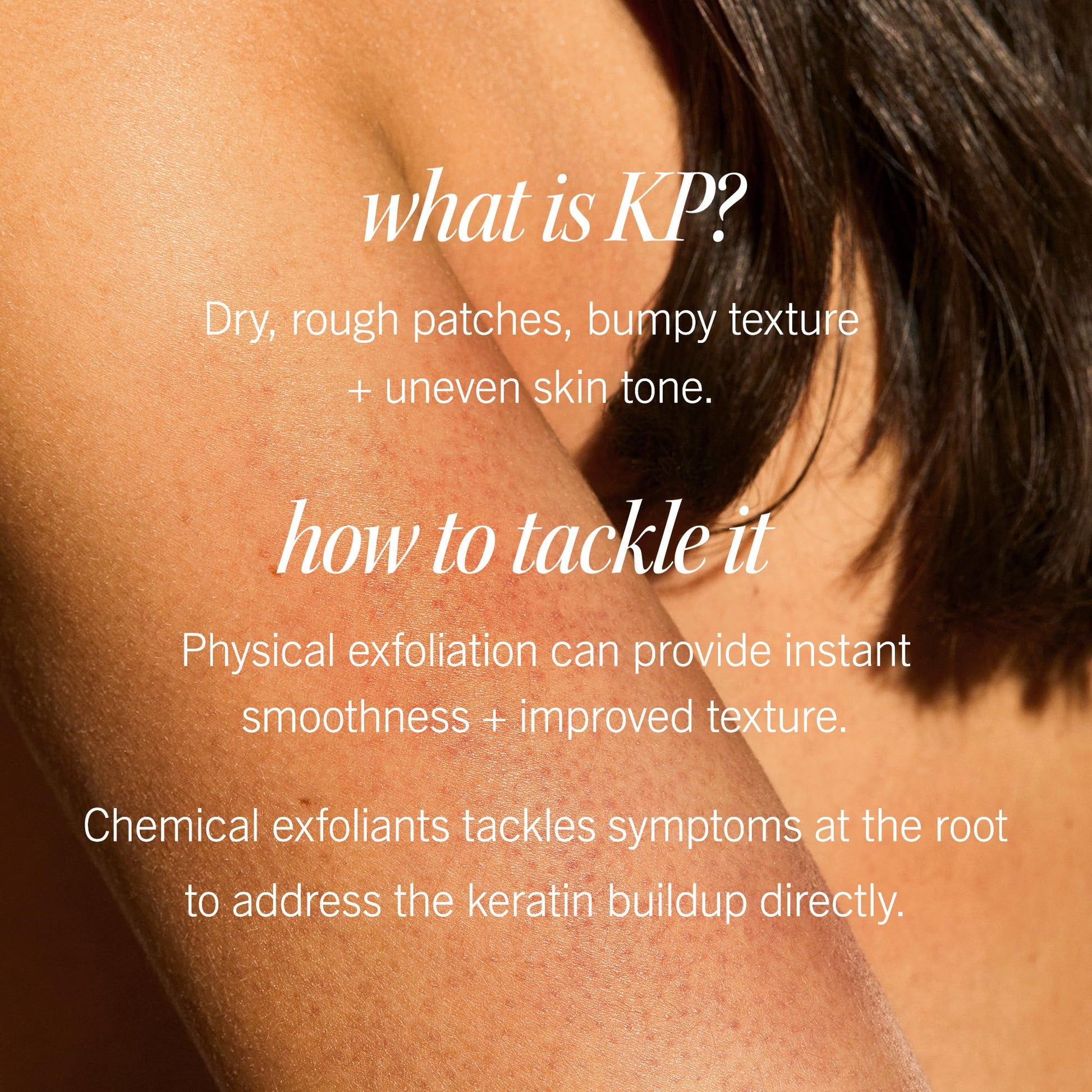 First Aid Beauty - KP Bump Eraser Body Scrub with 10% AHA, Keratosis Pilaris Exfoliator with Glycolic and Lactic acids, Helps Reduce Chicken Skin Bumps - PrimeBioHealth - canada supplements