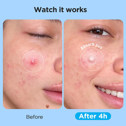 Glowpatch Pimple Patches for Face (504 Count), FSA Eligible Acne Patch Bulk, Zit Stickers 4 Sizes, Hydrocolloid Spot Stickers - PrimeBioHealth - canada supplements
