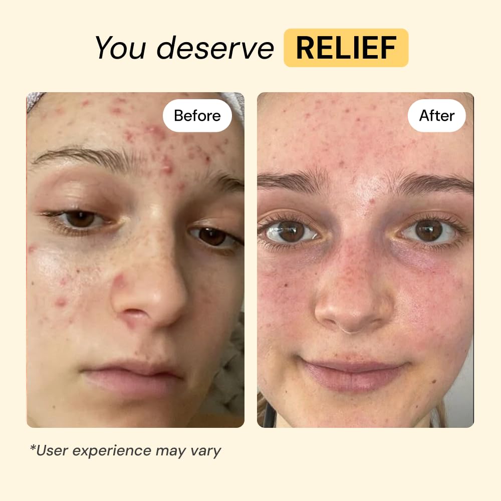 MyMagicHealer Thyme & Tea Tree Flare Care | Cystic Acne, Folliculitis, Ingrown Hair, Keratosis Pilaris, Razor Bumps, Body Bumps, Blind Pimples Multi-purpose Solution - PrimeBioHealth - canada supplements