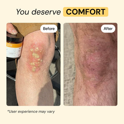 MyMagicHealer Universal Flare Care | Essential Oil Free | Baby Dermatitis, Diaper Rash, Eczema, Psoriasis, Impetigo | Wound Car - PrimeBioHealth - canada supplements