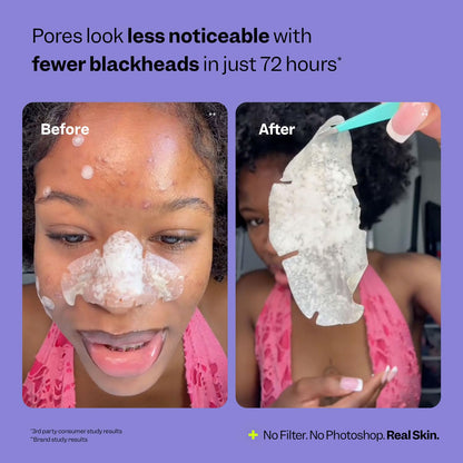 Peach Slices - Nose Pore Patches (7 ct) - Overnight Blackhead Remover - Pore Strips - Absorbs Gunk - Thin, Flexible & Painless - Hydrocolloid Patches - PrimeBioHealth - canada supplements