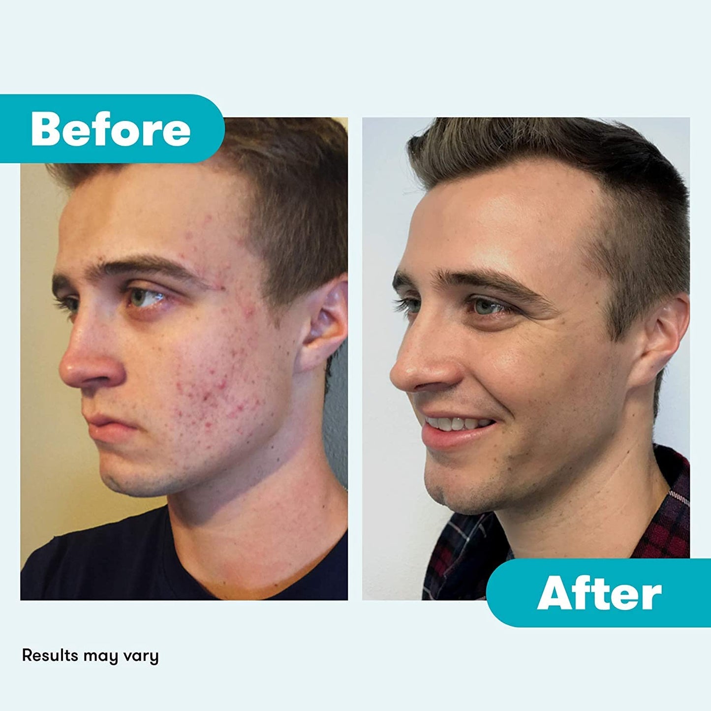 Proactiv Acne Cleanser - Benzoyl Peroxide Face Wash and Acne Treatment - Daily Facial Cleanser and Hyularonic Acid - PrimeBioHealth - canada supplements