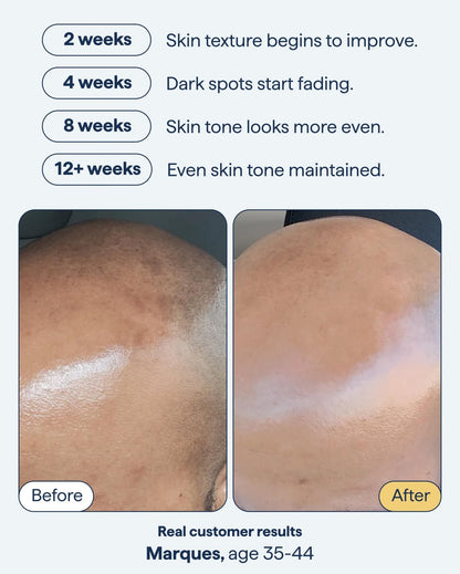 Remedy for Dark Spots | Advanced Night Treatment with Retinol & Kojic Acid | For Discoloration and Uneven Tones | With Glutathione - PrimeBioHealth - canada supplements