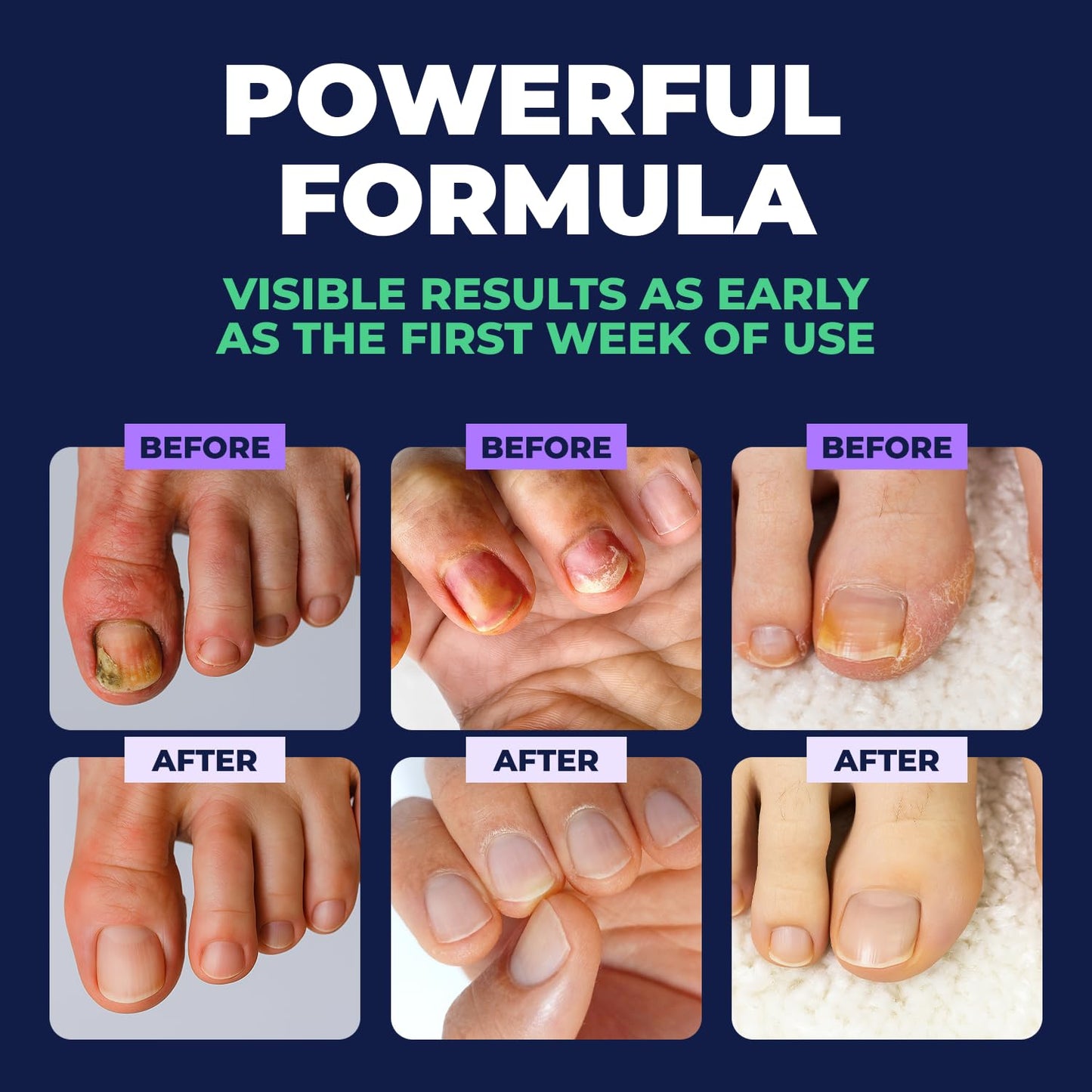 Toenail Care Pen - Extra Strength Toe Nail Remedy - Professional Nail Solution for Fingernail with Tea Tree Oil (Pack of 4) - PrimeBioHealth - canada supplements