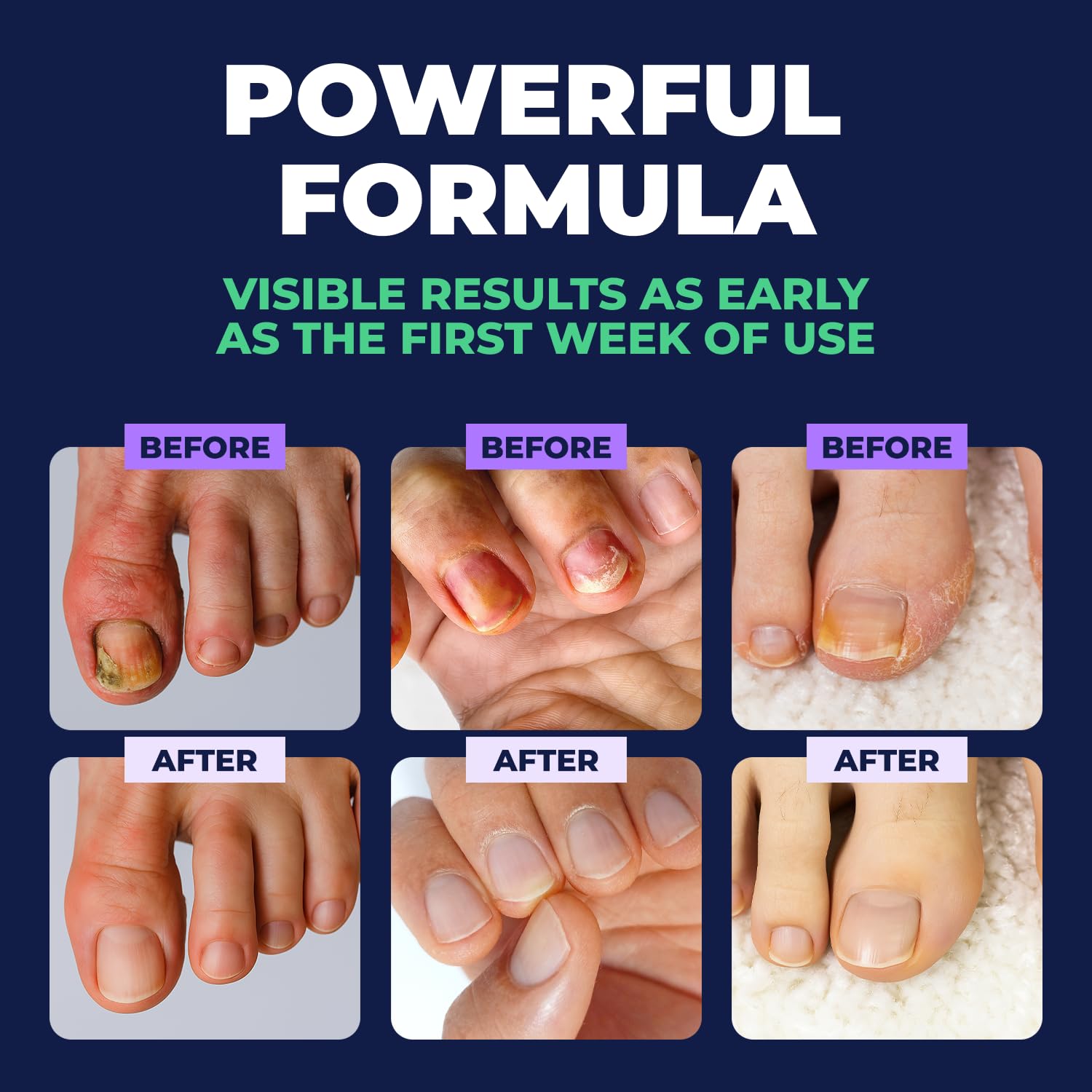 Toenail Care Pen - Extra Strength Toe Nail Remedy - Professional Nail Solution for Fingernail with Tea Tree Oil (Pack of 4) - PrimeBioHealth - canada supplements